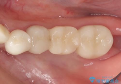 オールセラミッククラウン　銀歯を白い歯への治療後