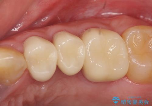 オールセラミッククラウン　根管治療・深い虫歯の治療の症例 治療後
