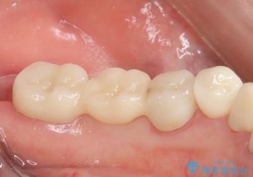 オールセラミッククラウン 銀歯を白い歯への治療後