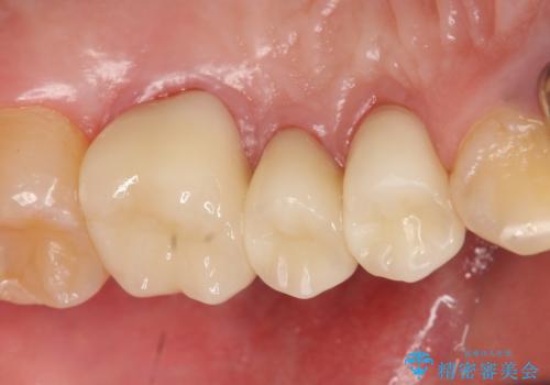 オールセラミッククラウン 根管治療・深い虫歯の治療の治療後