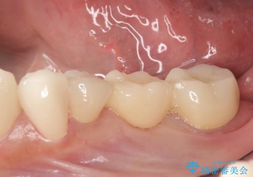 オールセラミッククラウン　銀歯を白い歯への治療後