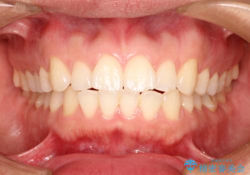 インビザラインで前歯のがたつきを目立たずに矯正治療の治療前