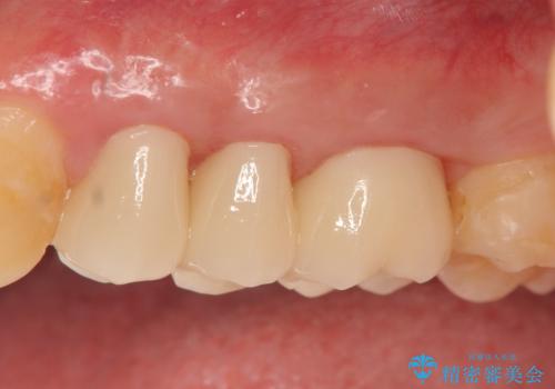 オールセラミッククラウン 根管治療・深い虫歯の治療の治療後