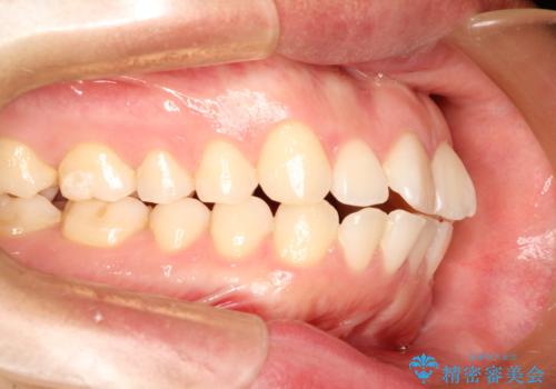 インビザラインで前歯のがたつきを目立たずに矯正治療の治療前