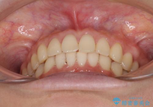 インビザラインによるディープバイトの改善の治療後