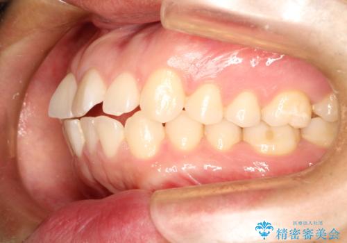 インビザラインで前歯のがたつきを目立たずに矯正治療の治療前