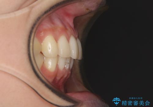 インビザラインによるディープバイトの改善の治療後