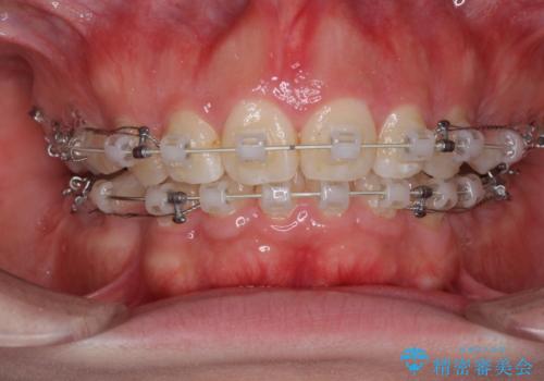 前歯がでていて口が閉じずらい　ワイヤーによる抜歯矯正の治療中