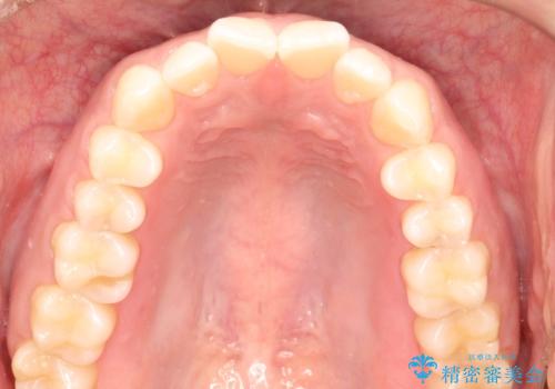 インビザラインで前歯のがたつきを目立たずに矯正治療の治療前