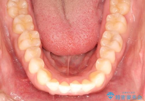 インビザラインで前歯のがたつきを目立たずに矯正治療の治療前