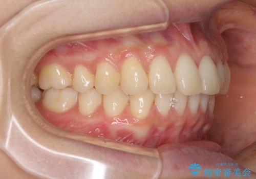 インビザラインによるディープバイトの改善の治療後