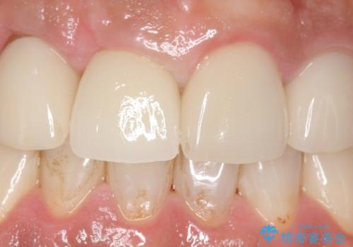 オールセラミッククラウン 土台ごと外れた前歯の補綴の治療後