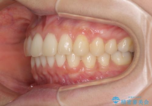 インビザラインによるディープバイトの改善の治療後