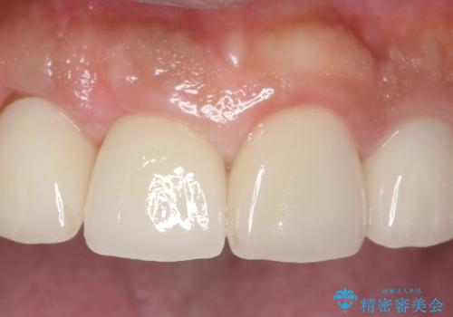 オールセラミッククラウン 土台ごと外れた前歯の補綴の症例 治療後