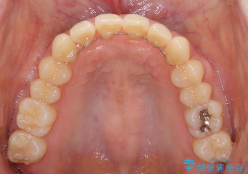 インビザラインによるディープバイトの改善の治療後