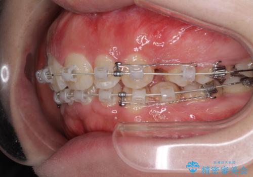 前歯がでていて口が閉じずらい ワイヤーによる抜歯矯正の治療中