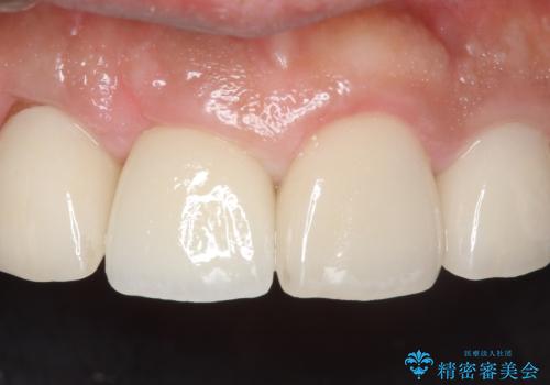 オールセラミッククラウン 土台ごと外れた前歯の補綴の治療後