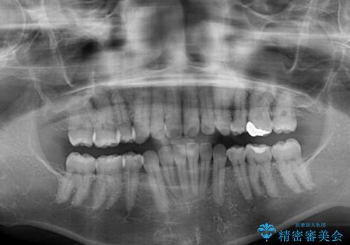 軽度な歯列不正 インビザライン・ライトによる矯正治療の治療前
