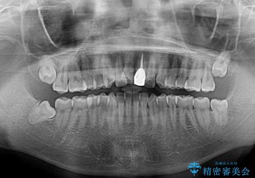 前歯の歯並びとクラウンを改善 インビザラインとオールセラミックの治療前