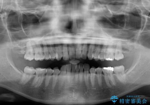 インビザラインによるディープバイトの改善の治療前