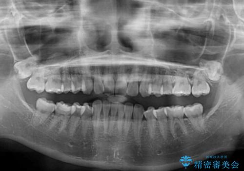 インビザラインによる前歯の矯正治療の治療前