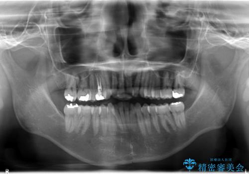 フルリンガル矯正　非抜歯でガタつきを整えるの治療前