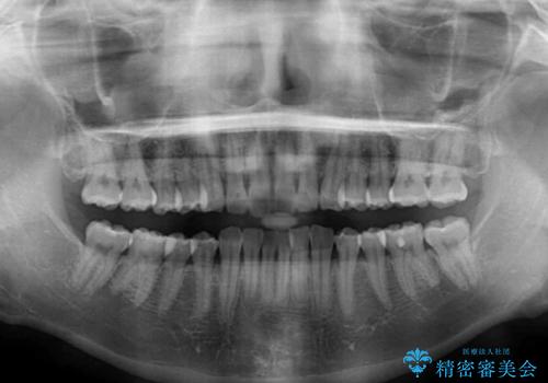 矯正治療の後戻りをインビザライン・ライトで改善の治療前