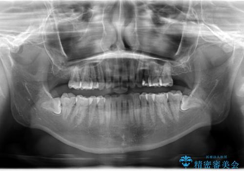 ハーフリンガル矯正 抜歯をして前歯を下げるの治療後