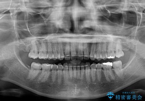 インビザラインによるディープバイトの改善の治療後