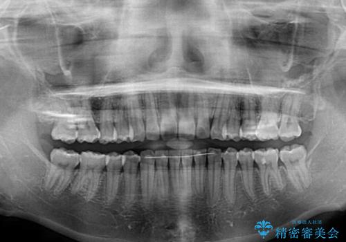 矯正治療の後戻りをインビザライン・ライトで改善の治療後