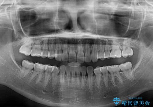 インビザラインによる前歯の矯正治療の治療後