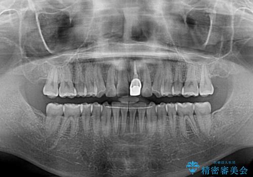 前歯の歯並びとクラウンを改善 インビザラインとオールセラミックの治療後