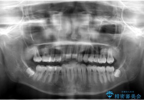 埋まっている犬歯を抜歯して、歯列矯正の治療後