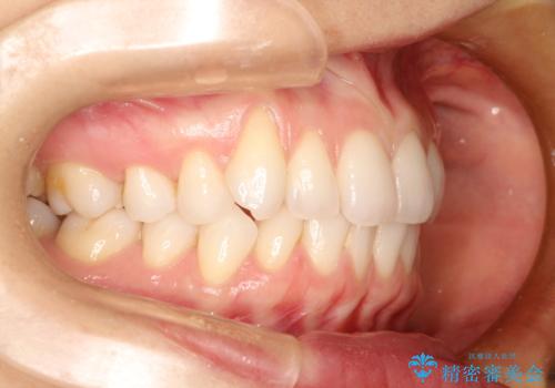 八重歯をマウスピース矯正で治療し、レーザーホワイトニングを行った症例の治療前