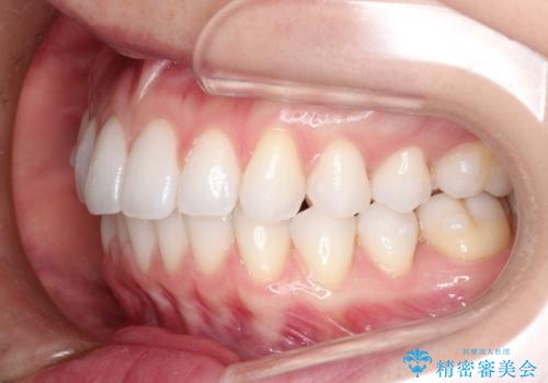 八重歯をマウスピース矯正で治療し、レーザーホワイトニングを行った症例の治療中
