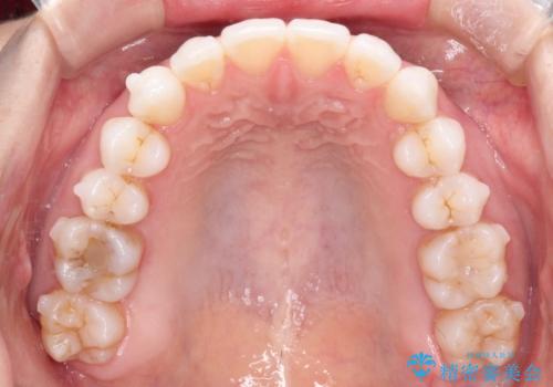八重歯をマウスピース矯正で治療し、レーザーホワイトニングを行った症例の治療中