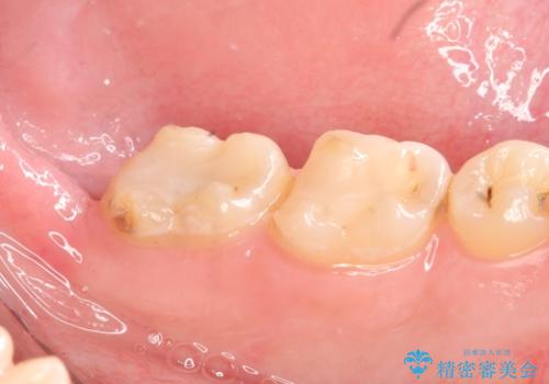 歯冠長延長術を併用した審美的セラミック治療の治療前