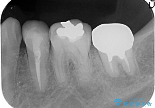 奥歯が痛い。根管治療からセラミッククラウンの治療前