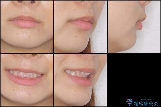 インビザラインによる前歯の矯正治療の治療前(顔貌)