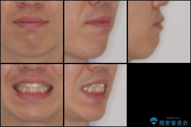 前歯の歯並びとクラウンを改善　インビザラインとオールセラミックの治療前（顔貌）