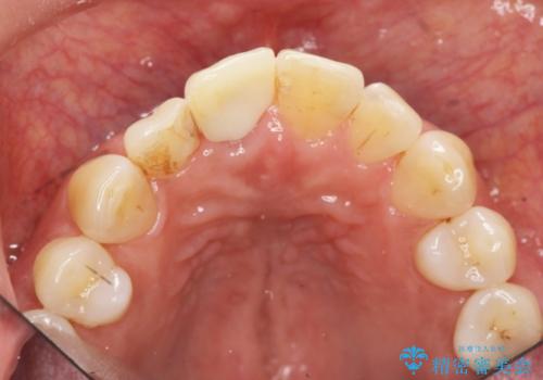 前歯 インプラントによる欠損補綴の治療後