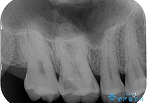 米国で笑われた 保険のつめものをやり直すの治療前