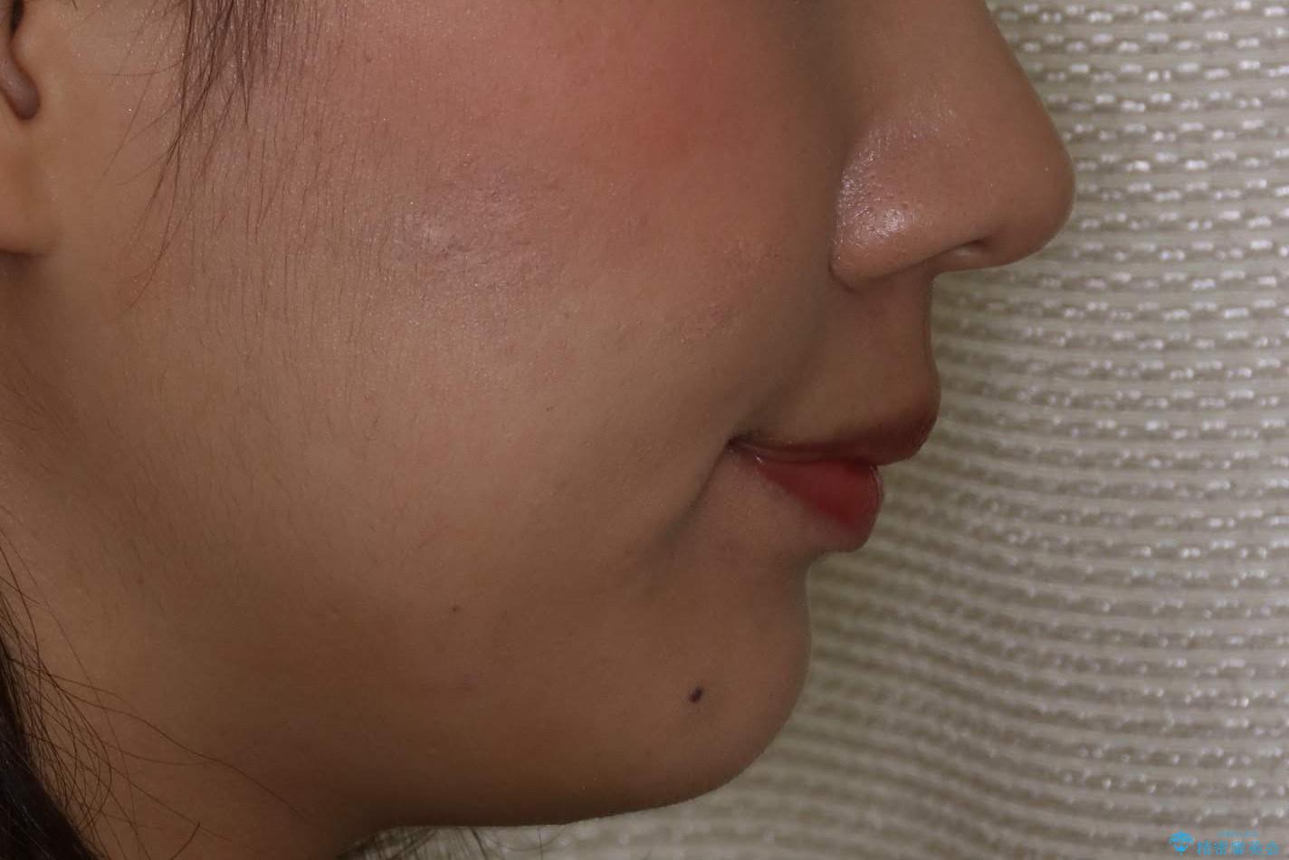 ハーフリンガル矯正 抜歯をして前歯を下げるの治療前(顔貌)