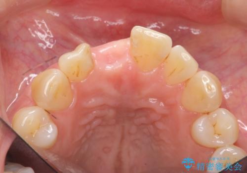 前歯 インプラントによる欠損補綴の治療前