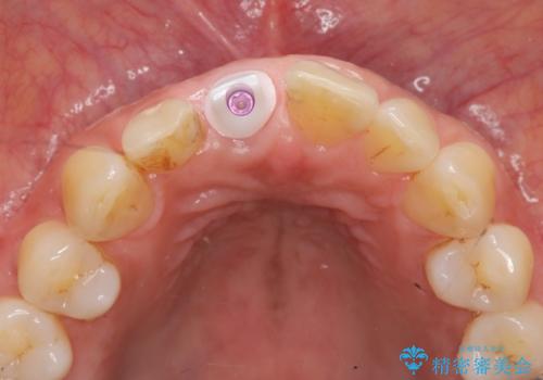 前歯 インプラントによる欠損補綴の治療中