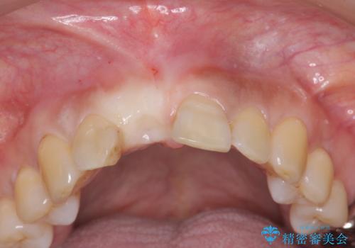 前歯　インプラントによる欠損補綴の治療前