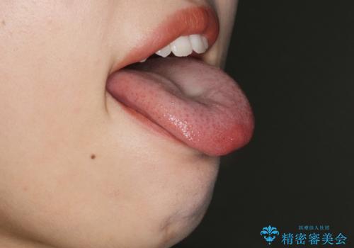 [舌小帯形成術]  舌が短く 話しづらい 　の治療中