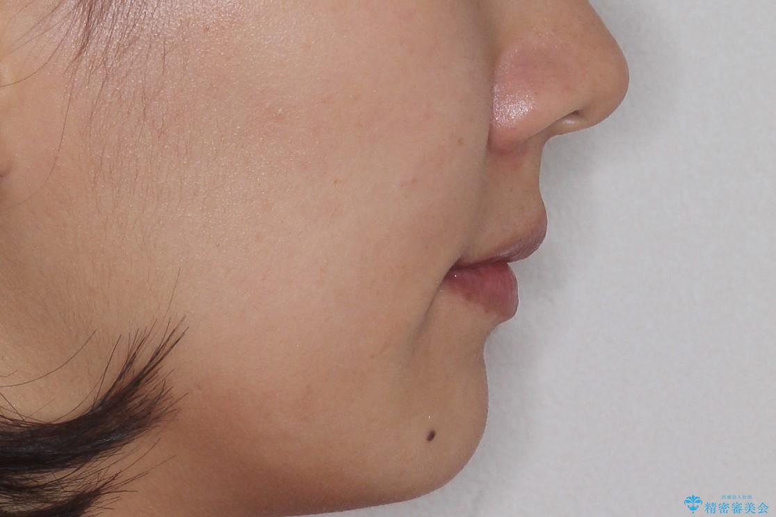 ハーフリンガル矯正 抜歯をして前歯を下げるの治療後(顔貌)