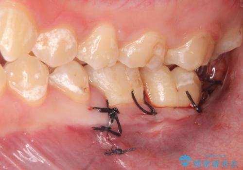 歯冠長延長術を併用した審美的セラミック治療の治療後