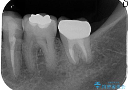 奥歯が痛い。根管治療からセラミッククラウンの治療後